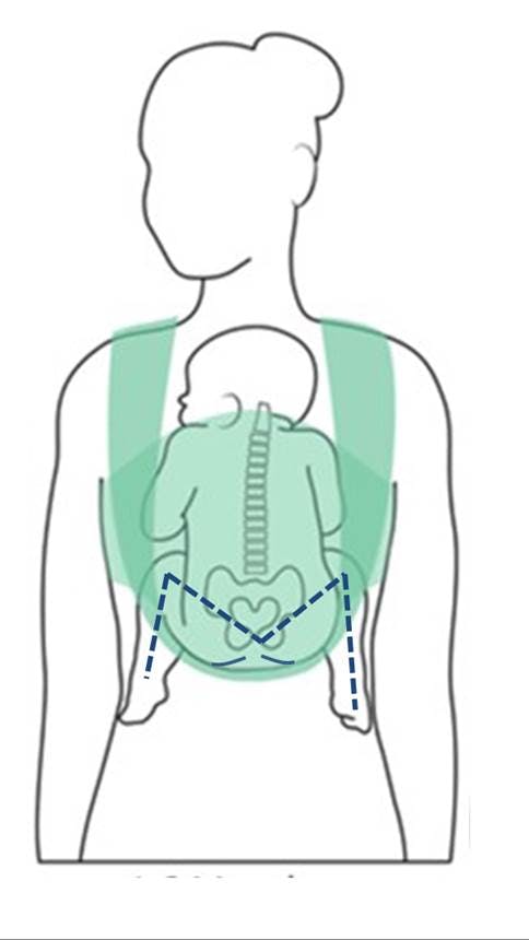 Infantino flip sale carrier hip dysplasia